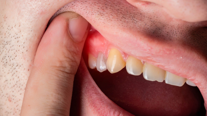 Why Do My Gums Hurt in One Spot