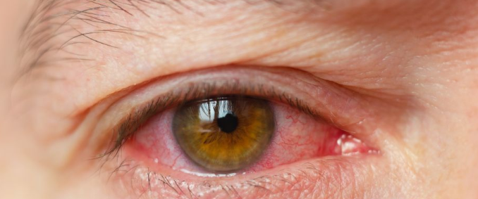 Pink Eye Symptoms